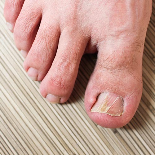 ingrown toenail treatment